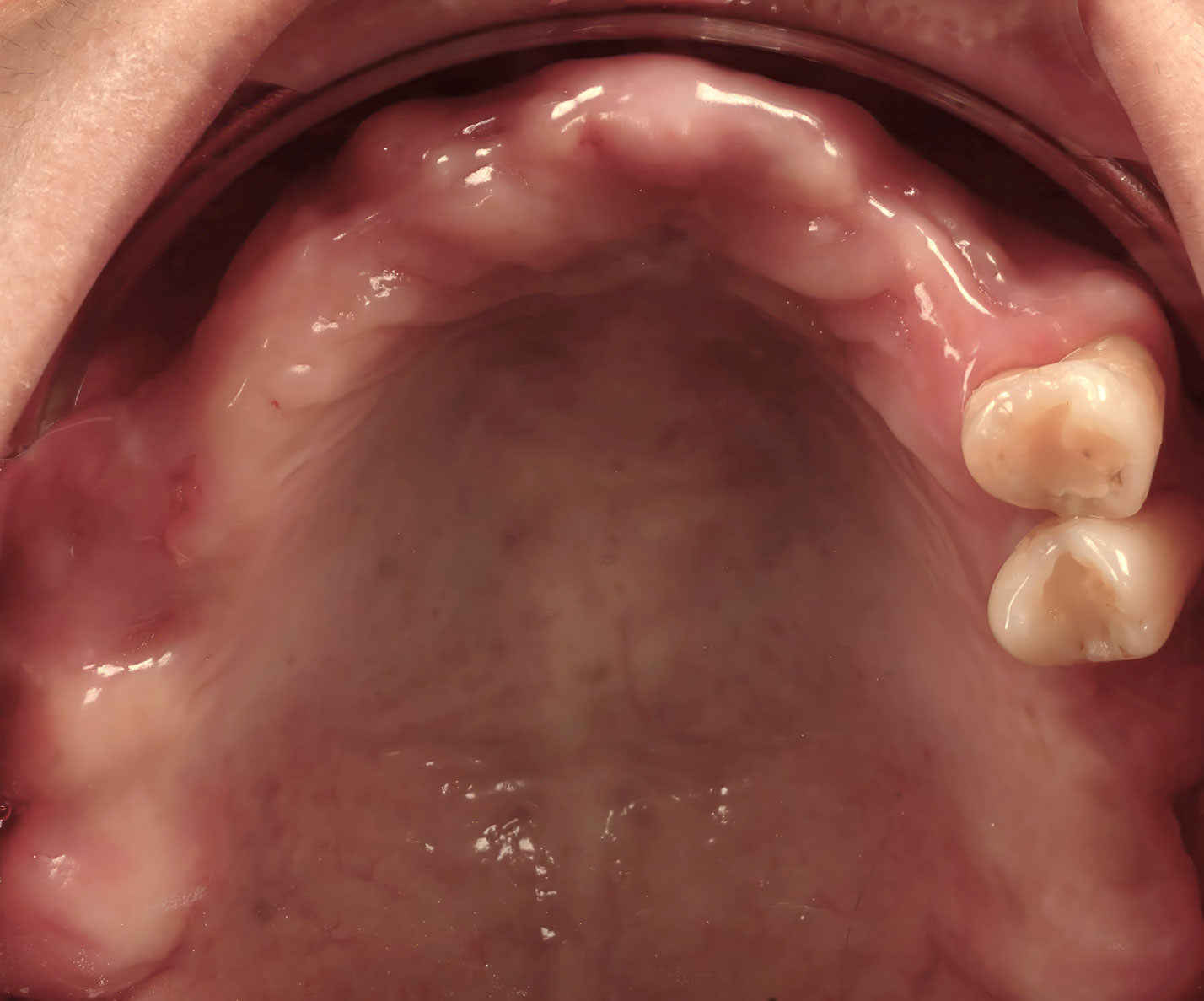 ภาพก่อนรักษาจากมุมมองด้านบน แสดงการสูญเสียฟันและสภาพช่องปาก